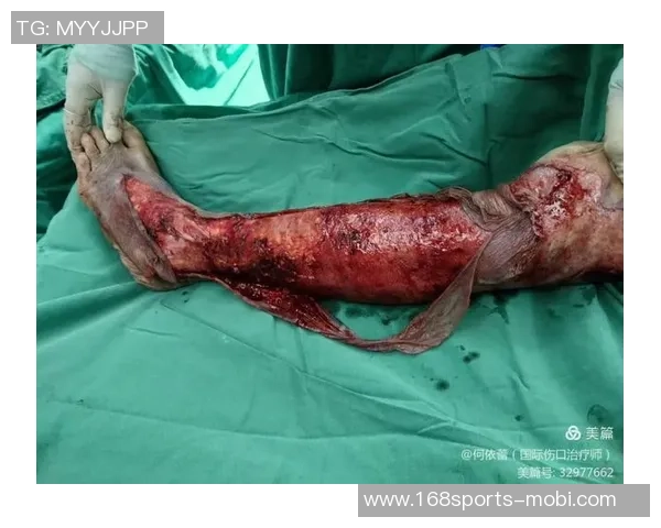 莱万遭遇重伤左大腿肌肉撕裂预计缺阵四到六周